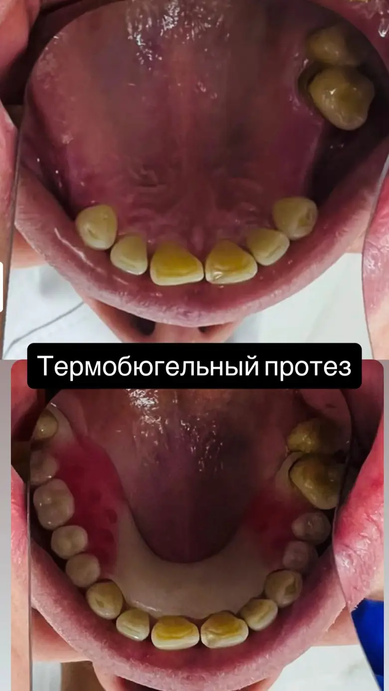Кейс: термобюгельный протез